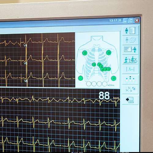 ECG