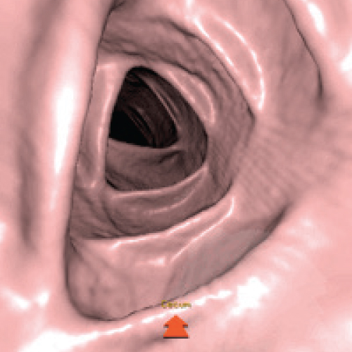 Diagnostica per immagini – Colonscopia virtuale