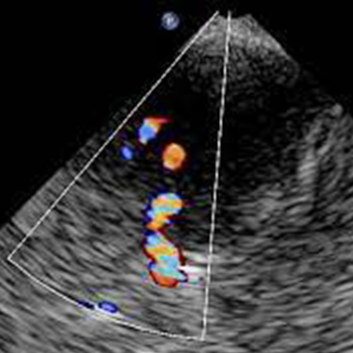 Eco-color-doppler trans cranico