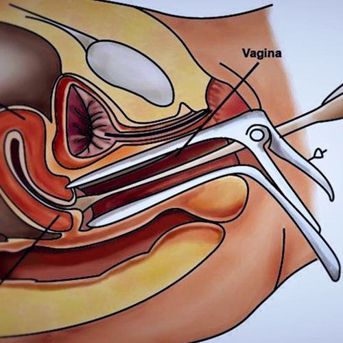 Esame colpocitologico – Pap test