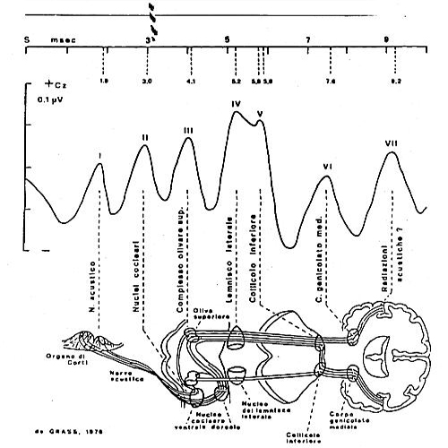 Potenziali evocati acustici (ABR)