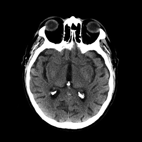 Tomografia assiale computerizzata (TC) cerebrale