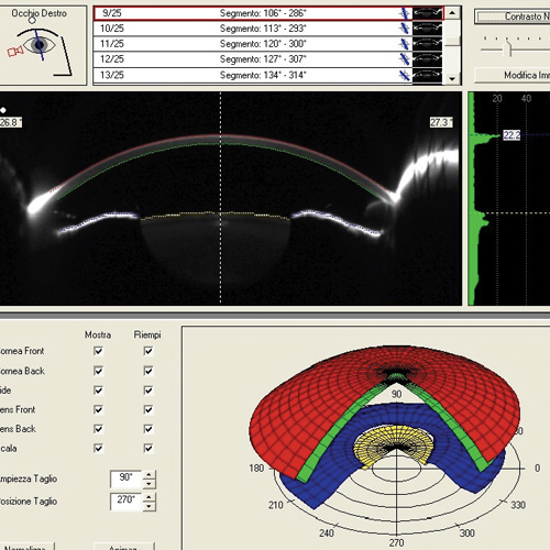 Tomografia del segmento anteriore mediante Optovue Pentacam®