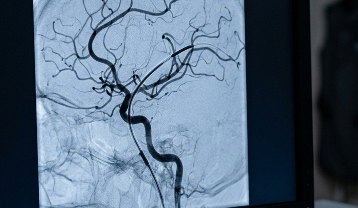Angiografia digitale